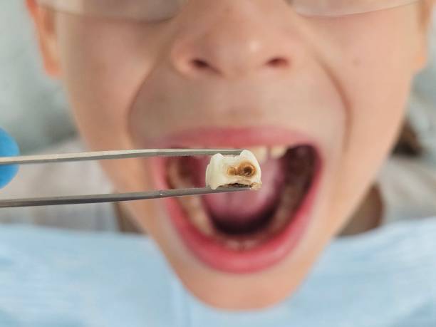 Best Emergency Dentist for Knocked-Out Tooth in Rlsbad, CA